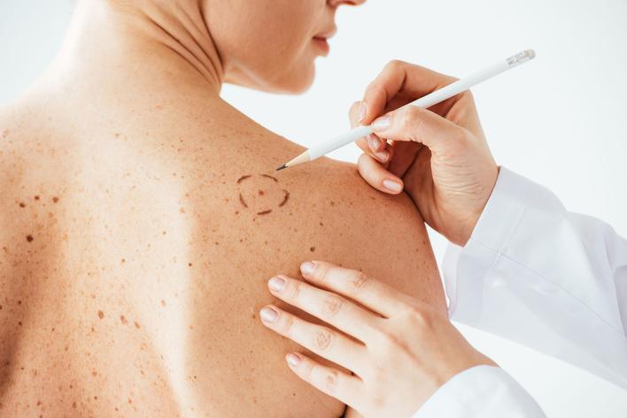 La Jefa de nuestro Servicio de Dermatología nos explica cuáles son las características que deben alertarnos cuando observamos nuestra piel.